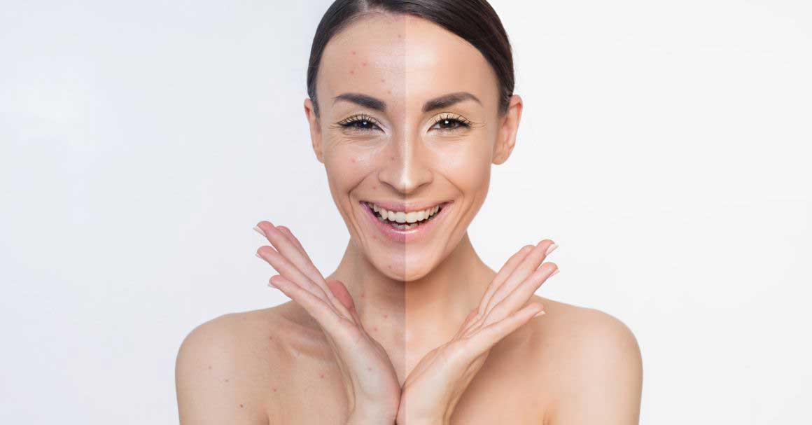  Zašto nastaju bubuljice od šminke i kako da ih se rešiš?