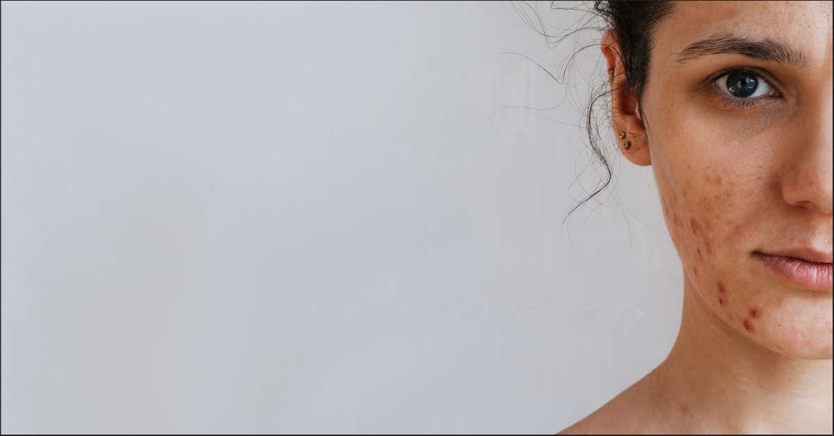 acne vulgaris